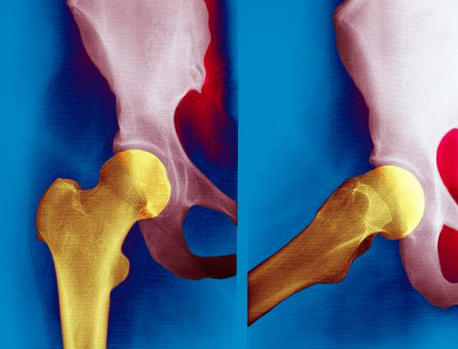 疫情之下，需警惕股骨头坏死的风险