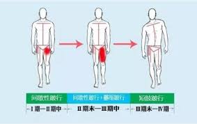 股骨头坏死治疗偏方整理详解